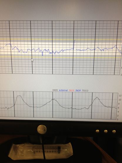 .Contraction - Heart Rate Graph